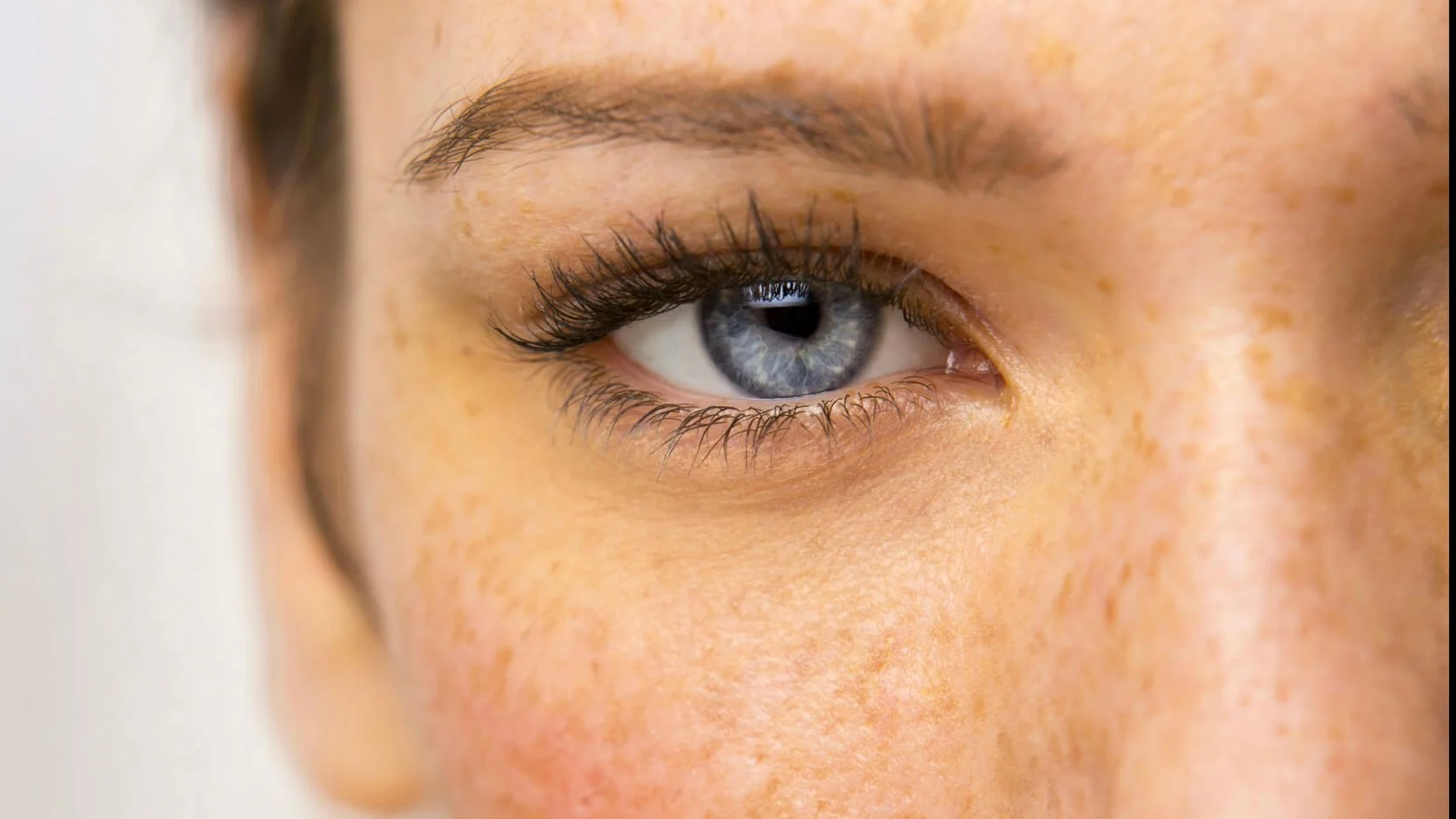 melanotan freckles Freckles vs Moles: How to Spot the Difference