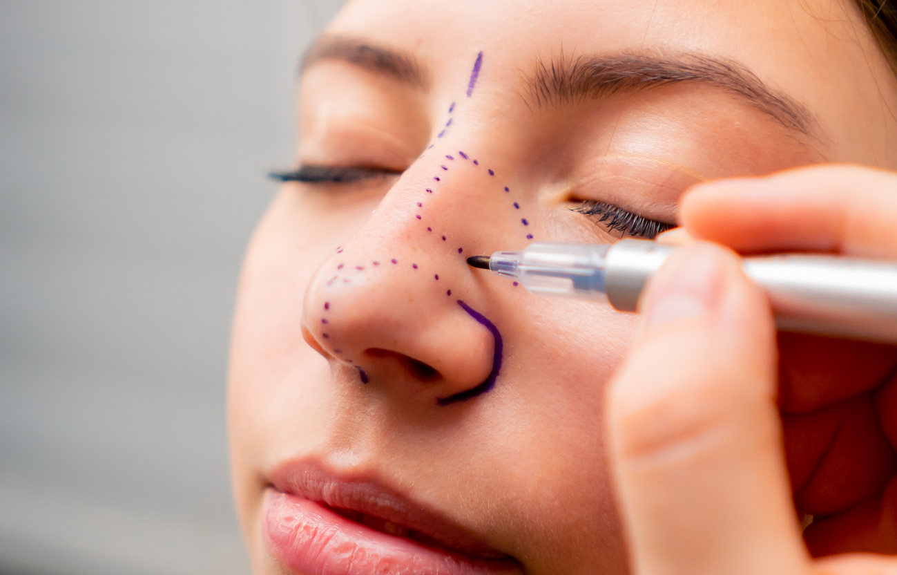 A surgeon is making lines on a woman's face for her nose reduction in Oklahoma city.