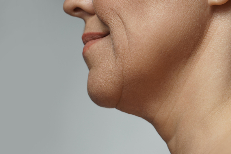 This close up picture of a woman's lower face shows what her face looked like before her facelift in Jacksonville