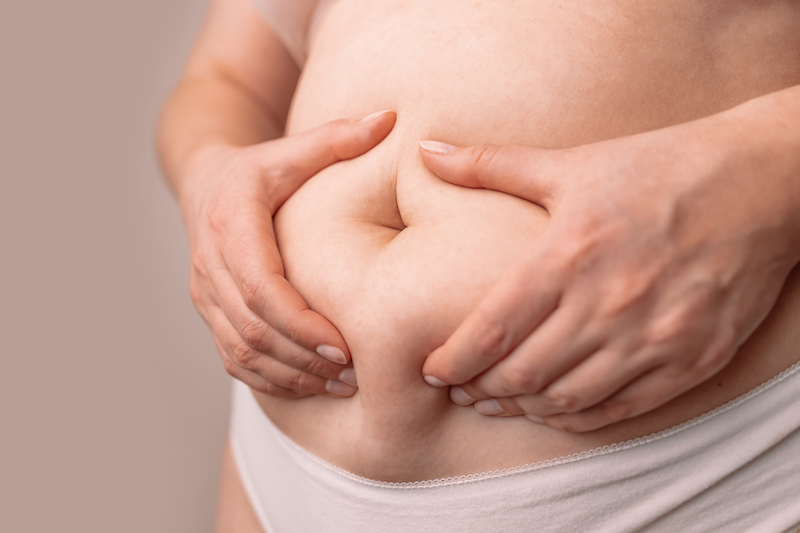 A woman is holding her subcutaneous fat before stomach fat removal in OKC.