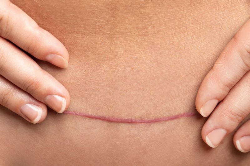 A woman is touching her scar after a highly effective abdominoplasty in OKC.