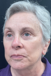 An after picture of a mature female patient who has had facial surgery in Oklahoma City. Lines and wrinkles are diminished, under-eye bags are lessened, and sagging cheeks have been lifted.
