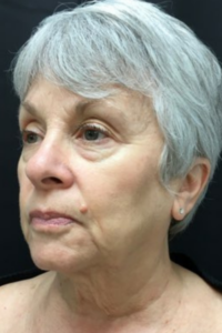 A before picture of a mature patient's face, showing her all of her classic signs of aging prior to having facial surgery in Oklahoma City.