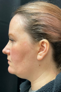 A female patient's before picture prior to her neck lift. She wants to redefine her jaw line and erase her double-chin with facial surgery in Oklahoma City.