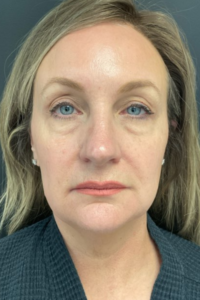 A before shot of a woman's face, prior to her having a brow lift as part of her facial surgery in Oklahoma City.