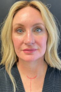 An after picture of a woman's face after she had a brow lift as part of her facial surgery in Oklahoma City. It shows significant results that look both natural and rejuvenating.