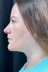 An after picture of a female patient who has had facial surgery in Oklahoma City. Her jawline is much better defined, and her double-chin is gone.