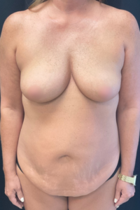 In this abdominoplasty before-and-after photo, a patient is experiencing an apron belly.