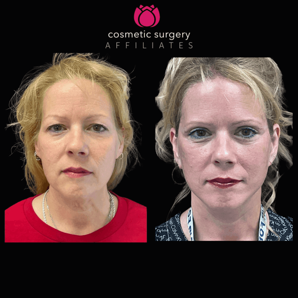 a woman's before and after photos of a smart face lift and upper bleph procedure