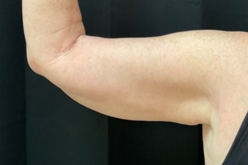 A patient shows her upper arm prior to arm skin removal in Jacksonville.