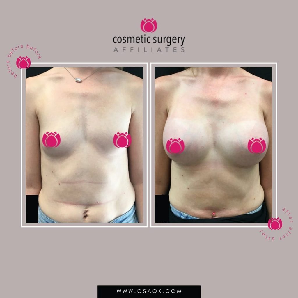 What Do Breast Augmentation Results Actually Look Like Immediately After Surgery