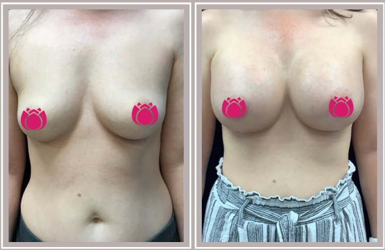 Will Your Implants Look "Too High" Right After Surgery?