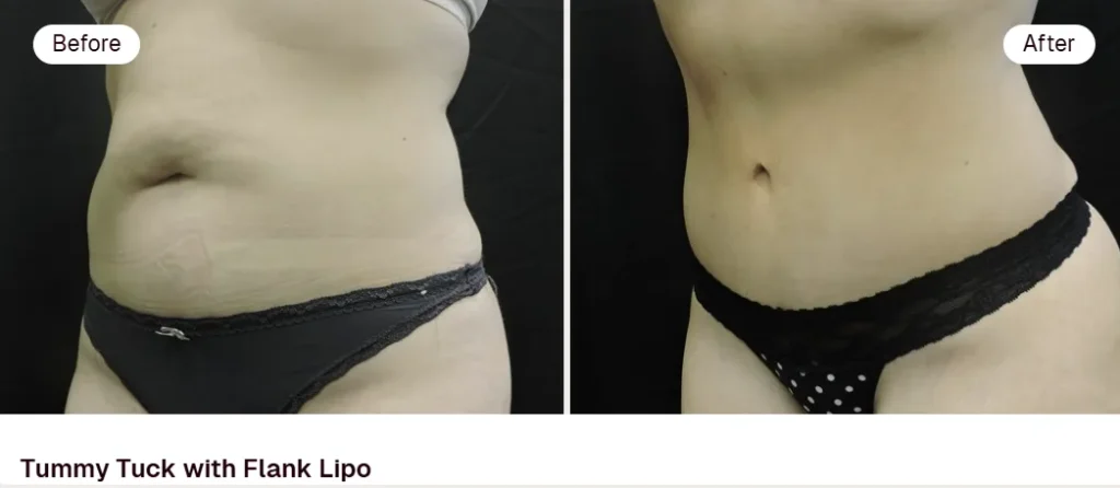 How is excess skin and fat removed and the abdomen reshaped?