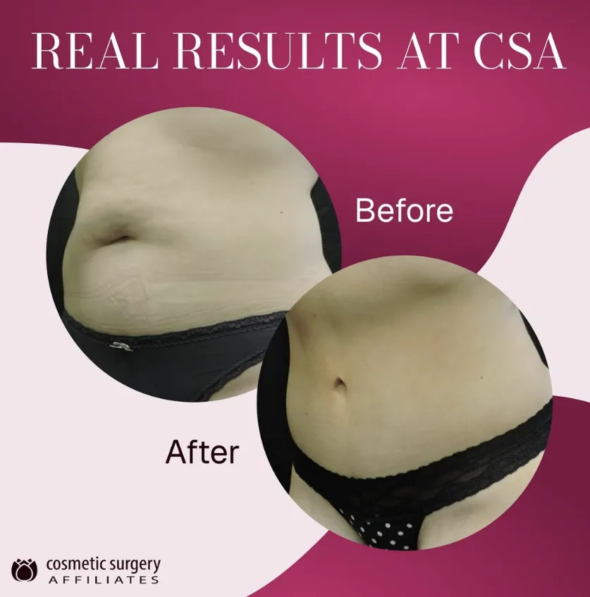 What Should You Expect During the First Week of Liposuction Recovery?