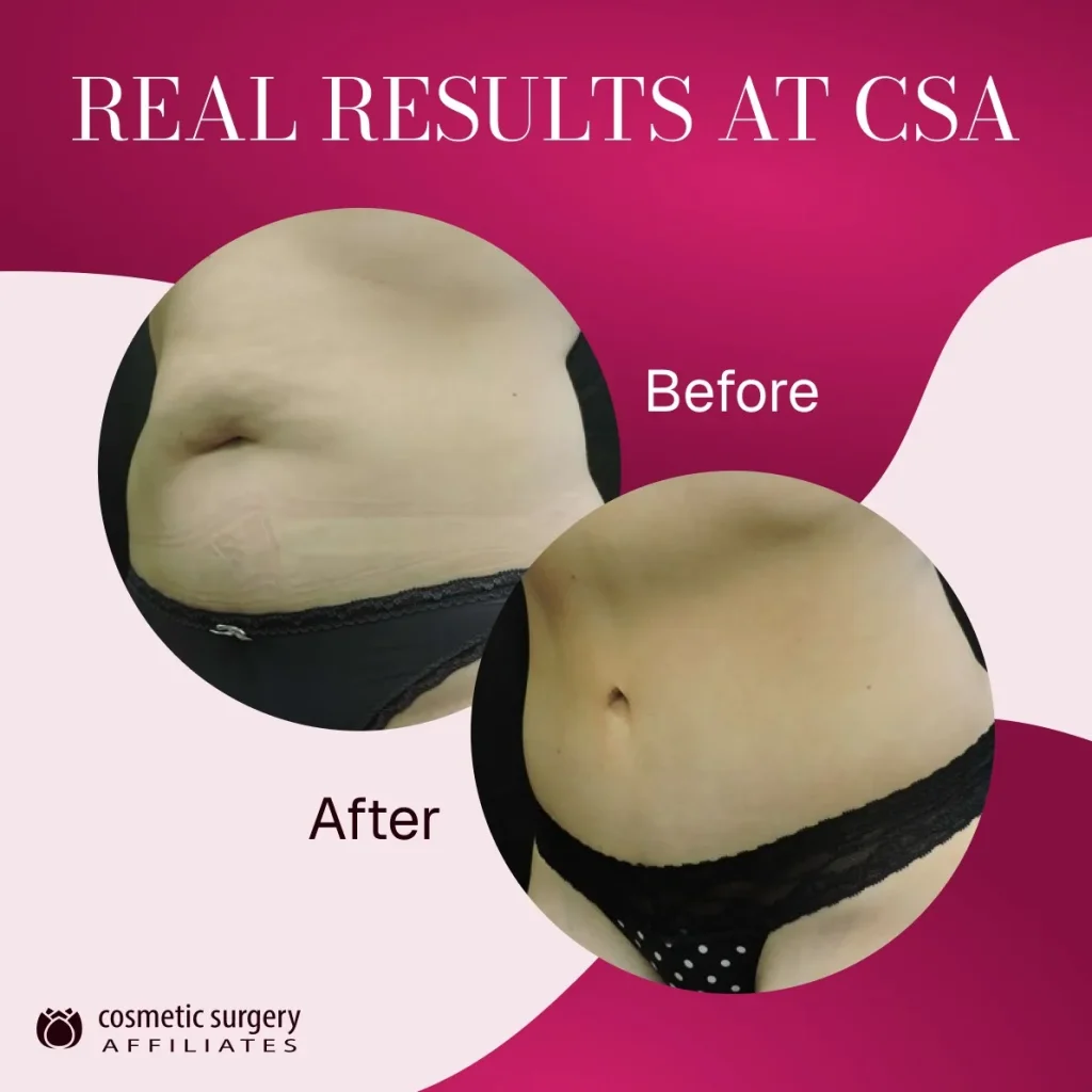 What about tummy tuck recovery and long term safety?