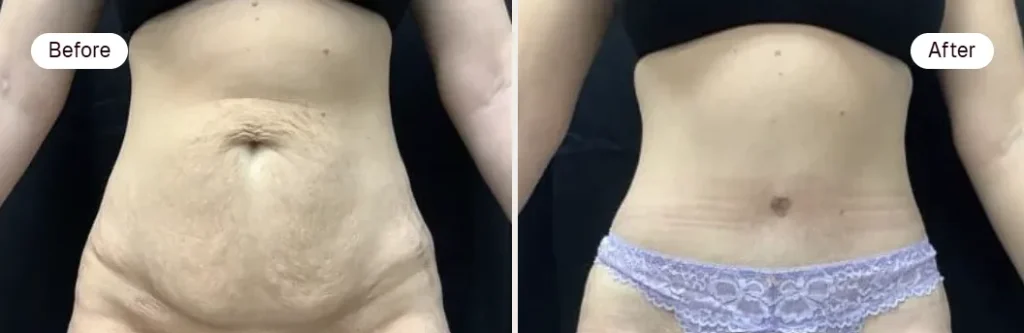 What results can I expect from a tummy tuck?
