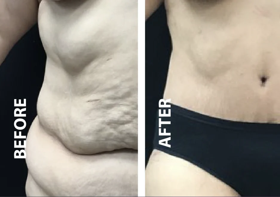 What are the right treatments for loose skin?