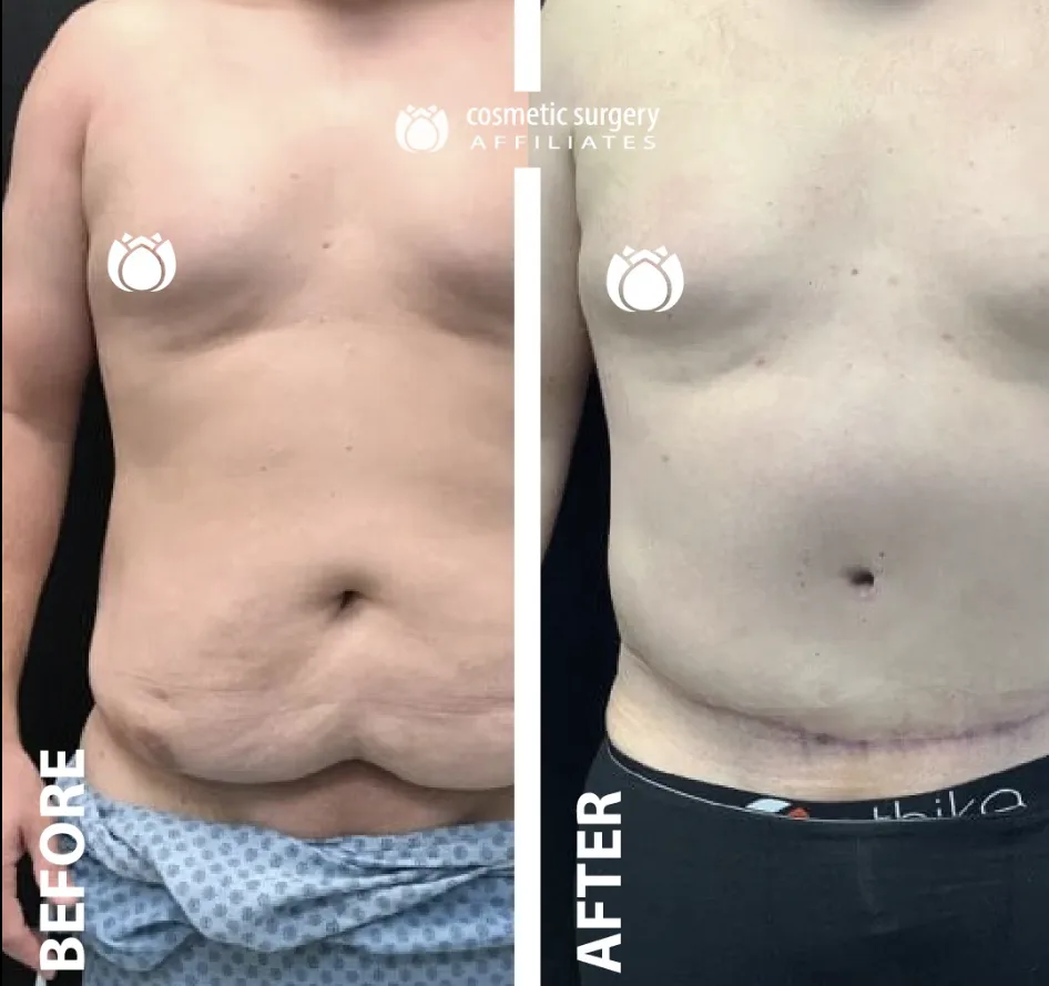 What's the real difference between a panniculectomy and a tummy tuck?