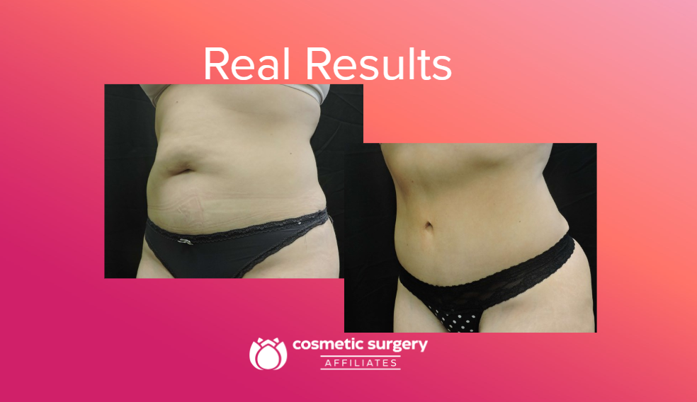 Tummy Tuck vs. Panniculectomy: Which One Is Right for Your Excess Stomach Skin?