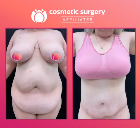 Am I a good candidate for a plus-size mommy makeover?