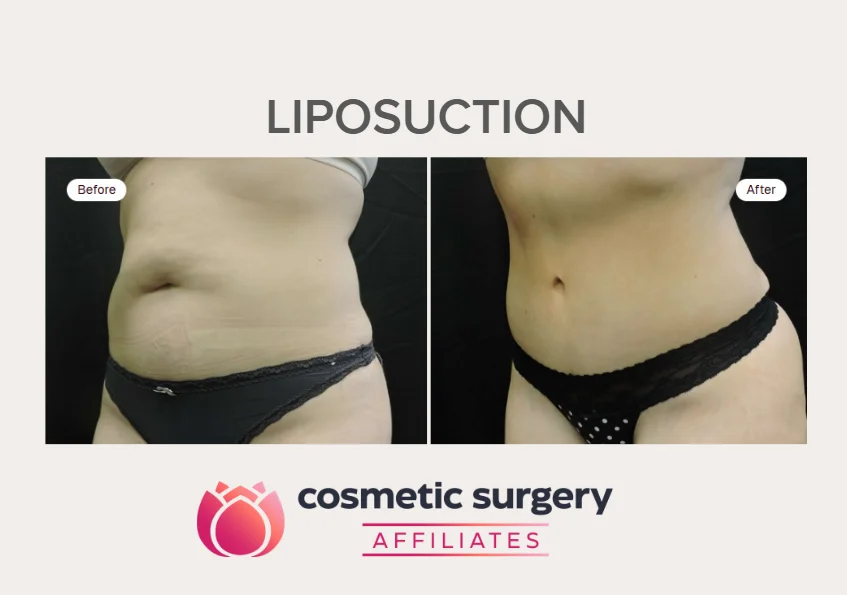 Does your age affect whether you can get liposuction?