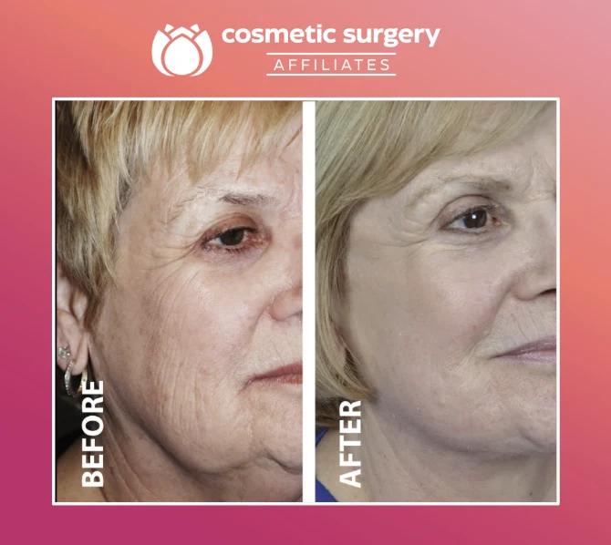 What is the difference between a lower facelift and a neck lift?