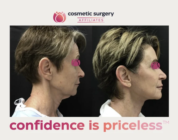 What surgical techniques are used to reshape the jawline and neck?