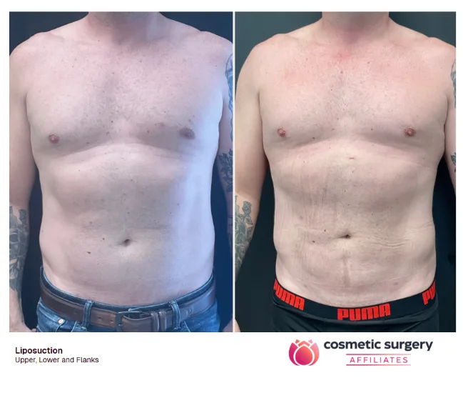 Who is, and isn't, a good candidate for liposuction?