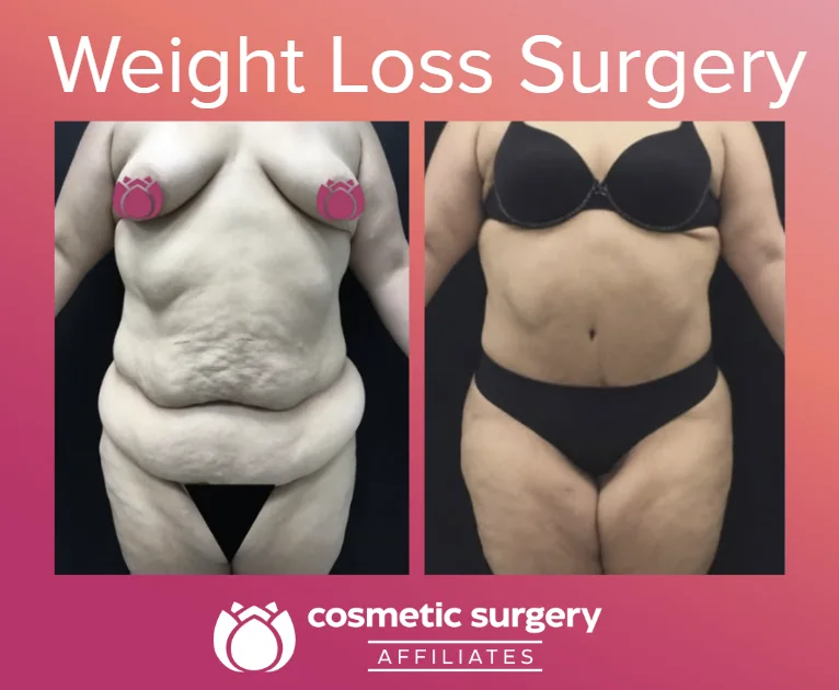 Why does loose skin hang around after major weight loss?