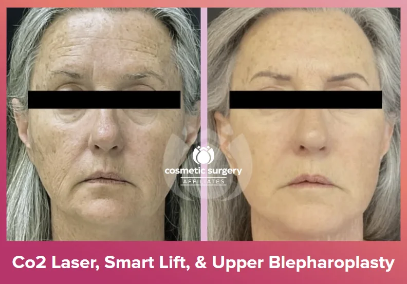 How do the different facelift techniques compare in results?