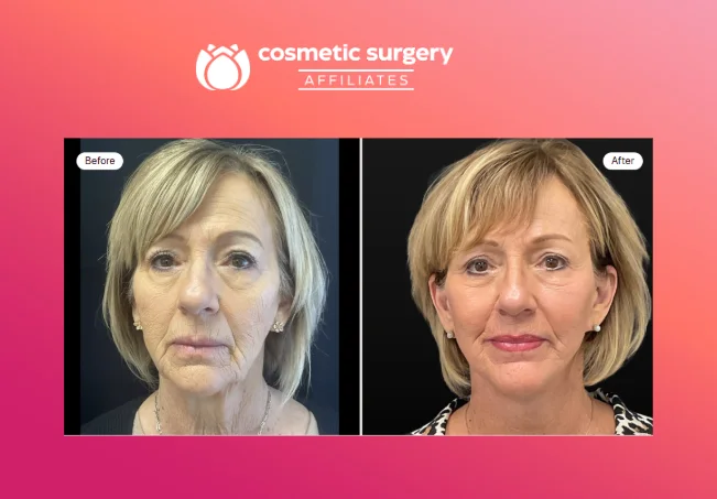 What results can you expect, and how do you choose a qualified facelift surgeon?