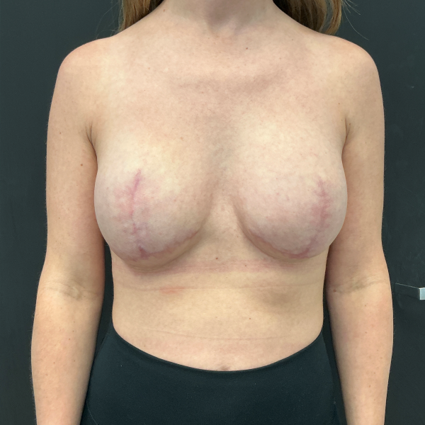 Mastectomy CSA