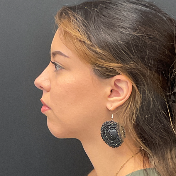 Neck lift with chin augmentation CSA
