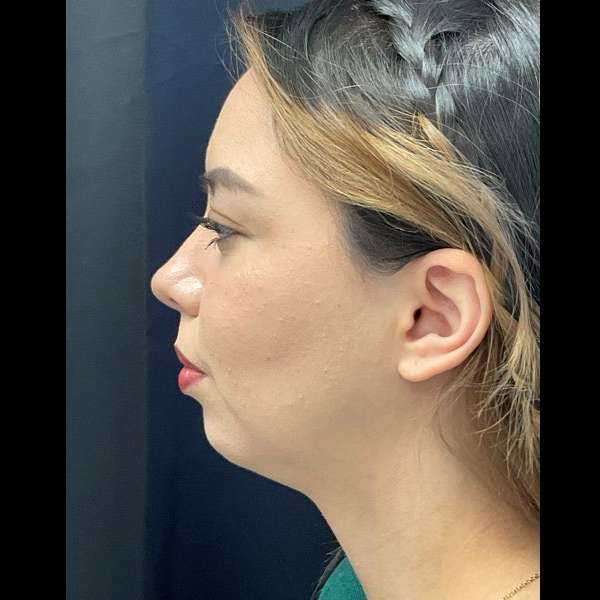 Neck lift with chin augmentation CSA