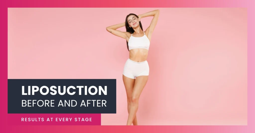 liposuction woman happy with results csa