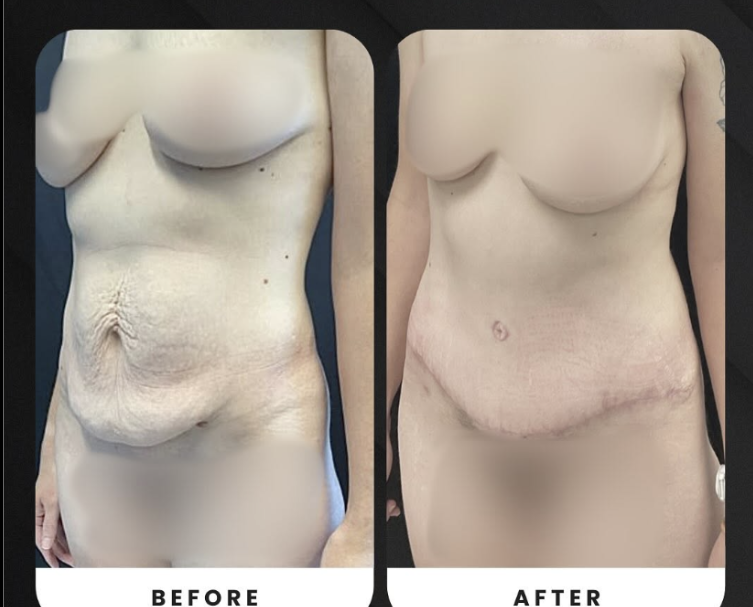 Surgeon marking a patient's abdomen before a tummy tuck with liposuction