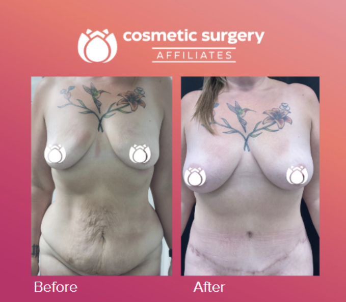 before and after real patient result after a tummy tuck at CSA