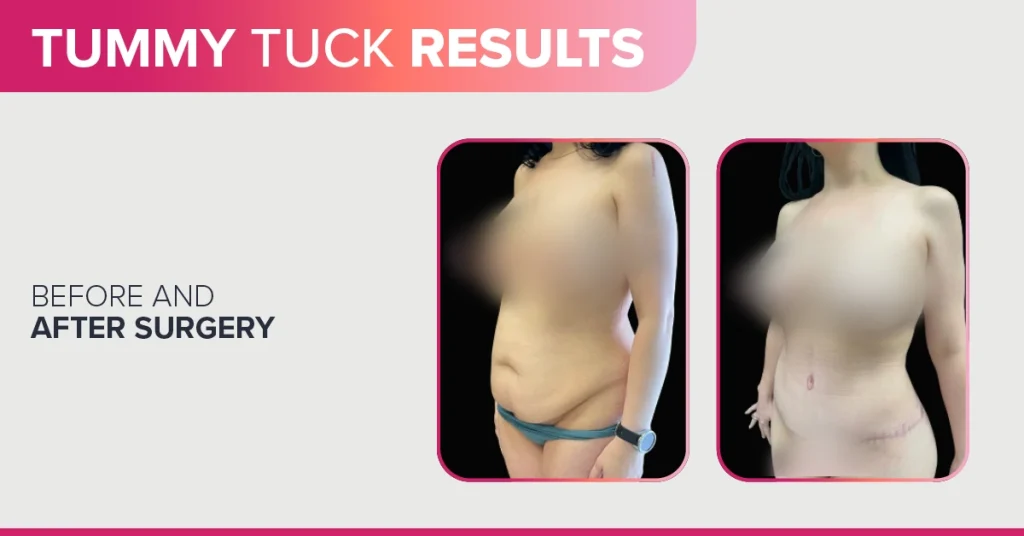 Tummy tuck results showing a flatter midsection - before and after - cosmetic surgery affiliates - OKC